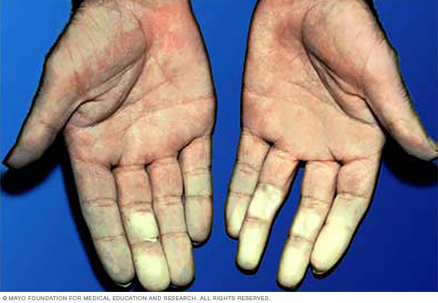 Hands affected by Raynaud's disease