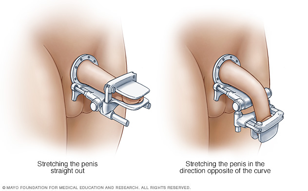 Penile traction device and method