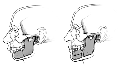 The lower jaw is divided and the front section is moved forward or backward and secured with plates and screws. 