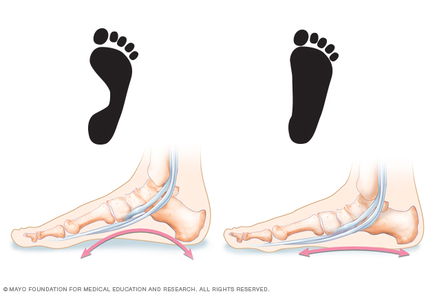 Pies planos // Middlesex Health