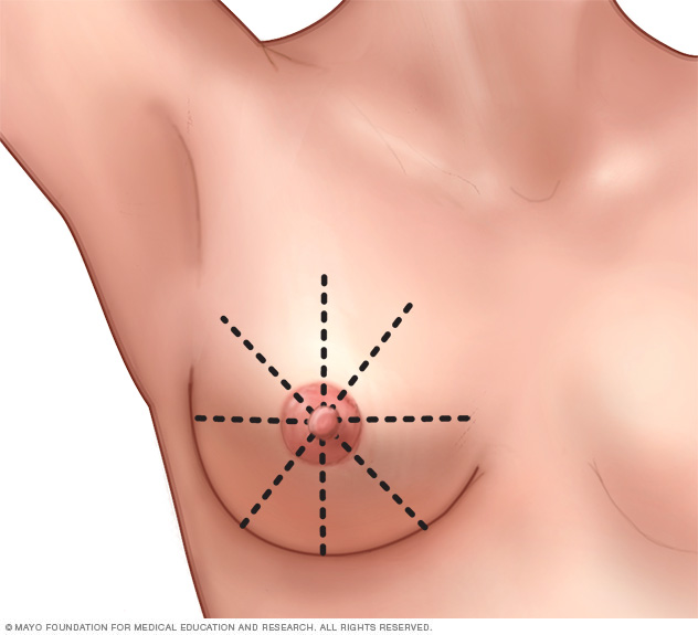 Wedge-shaped pattern for breast self-exam