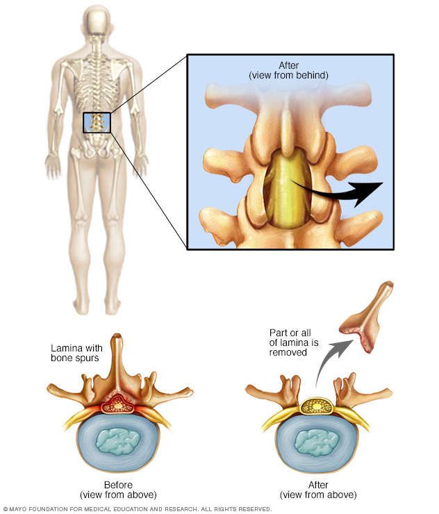 Laminectomía lumbar