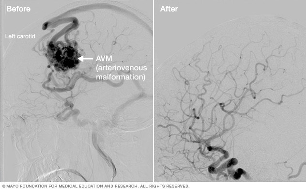 Resultados del tratamiento de malformaciones arteriovenosas cerebrales