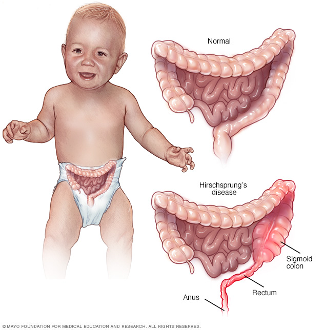 Hirschsprung S Disease Middlesex Health