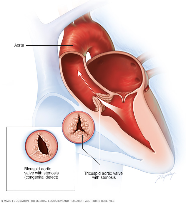 Aortic valve stenosis