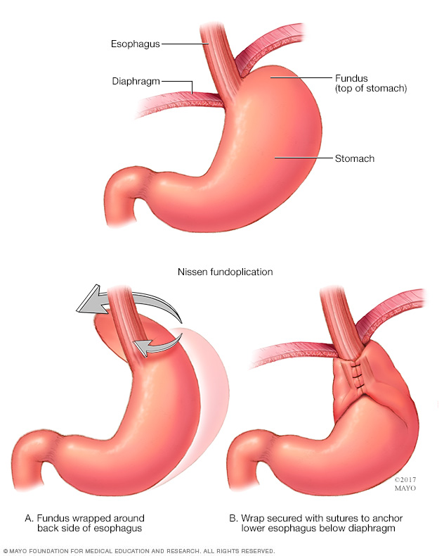 Fundoplicatura de Nissen 