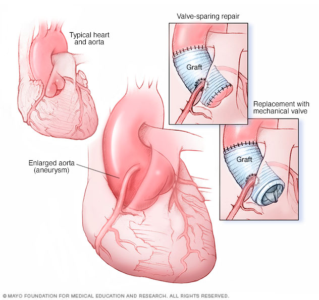 Ascending aortic root aneurysm procedure