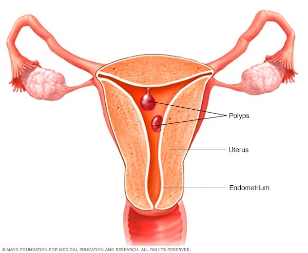 Uterine polyps