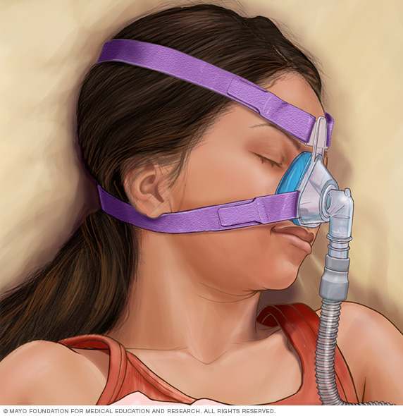 A girl sleeping with continuous positive airway pressure (CPAP)