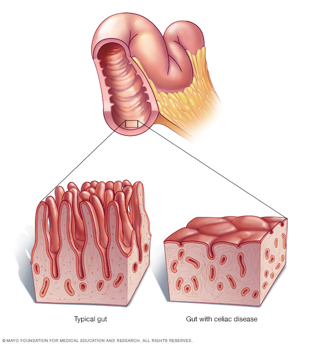 Celiac disease