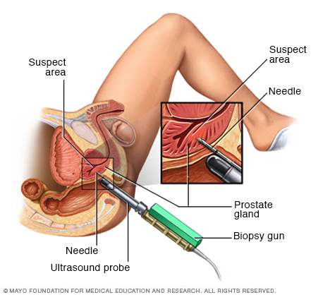 Biopsia transrectal de pr&oacute;stata