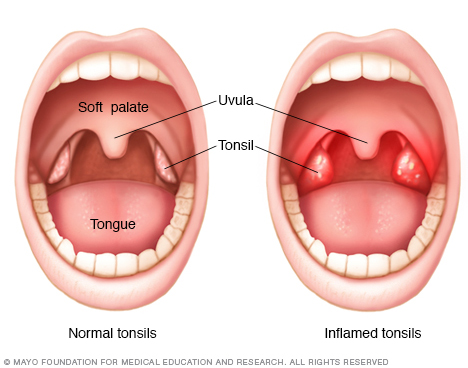 Inflamed tonsils