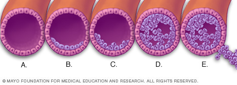 How breast cancer develops