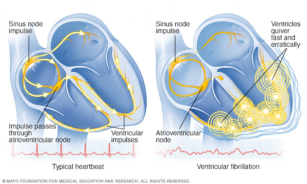 Fibrilación ventricular 