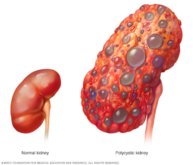 Kidney Cysts: Causes, Symptoms, Treatment & Prevention