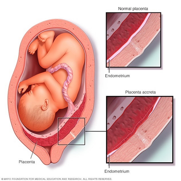 Placenta normal y placenta adherida