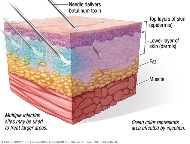 Several needles are used to inject botulinum toxin into a lower layer of skin.