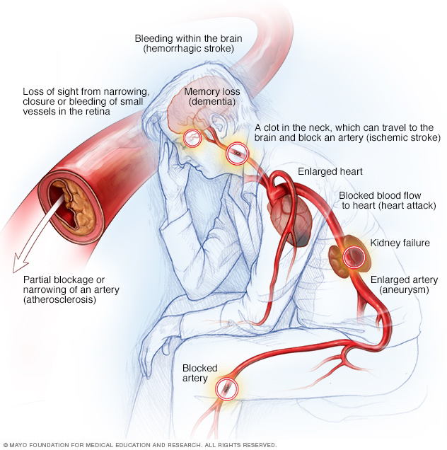 High blood pressure complications