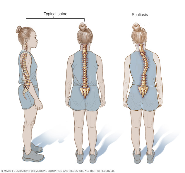 Scoliosis // Middlesex Health