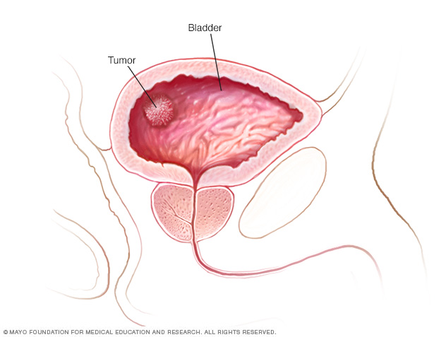 Tumor en la pared de la vejiga