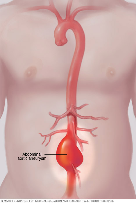 Abdominal aortic aneurysm