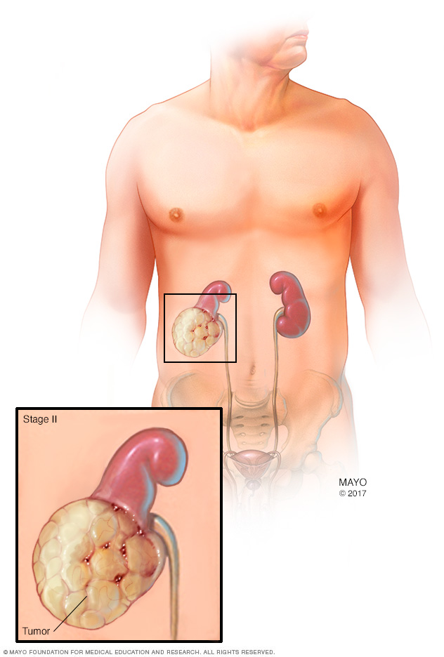 Stage II kidney tumor