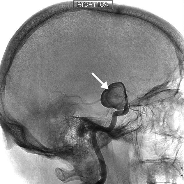 Angiografía cerebral