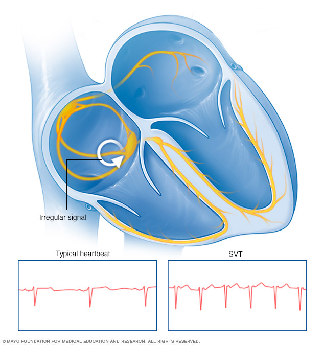 Supraventricular tachycardia (SVT)