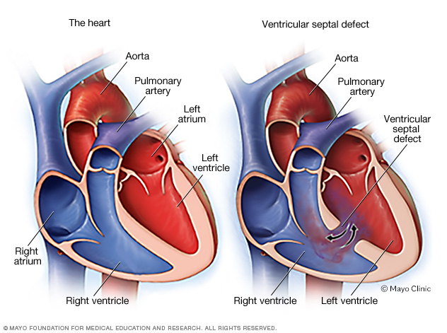 Defecto del tabique ventricular