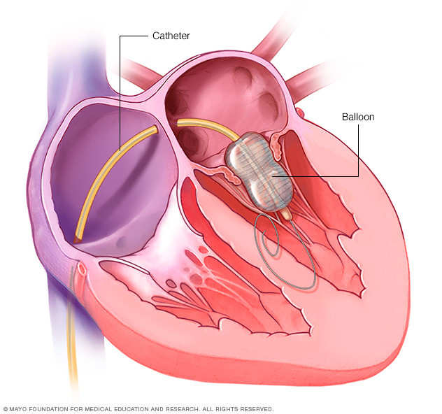 Balloon valvuloplasty