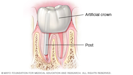 Illustration showing crown and tooth restoration