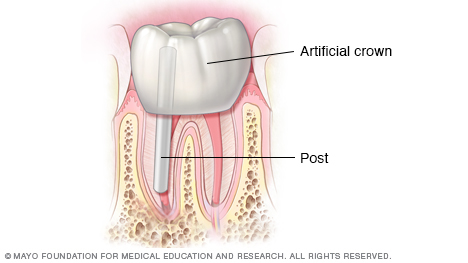 Ilustración que muestra una corona y un arreglo dental