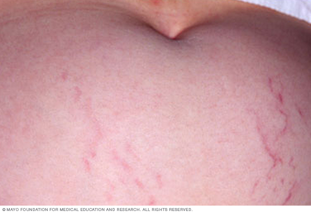 Stretch marks in pregnancy