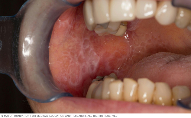 types of oral diseases