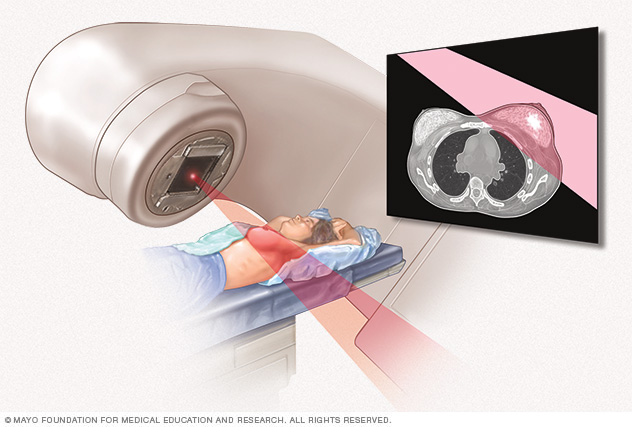 Breast cancer // Middlesex Health