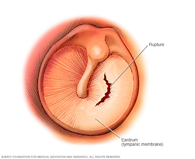 Eardrum showing rupture 