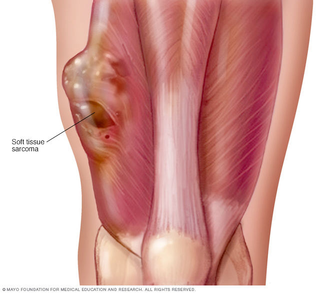 Soft Tissue Masses — What Is This Lump?: Surgical Associates of North  Texas: Advanced Laparoscopic Surgeons