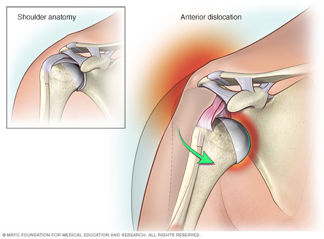 A dislocated shoulder