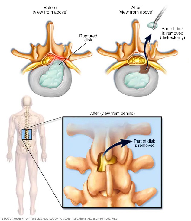 Removal of herniated portion of spinal disk