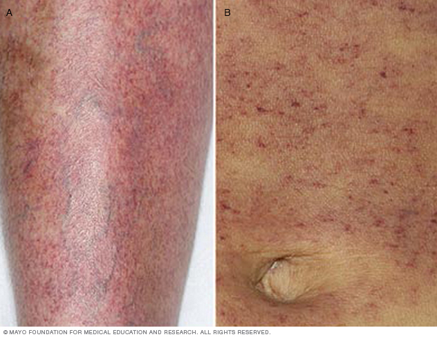 Petechiae on leg and abdomen