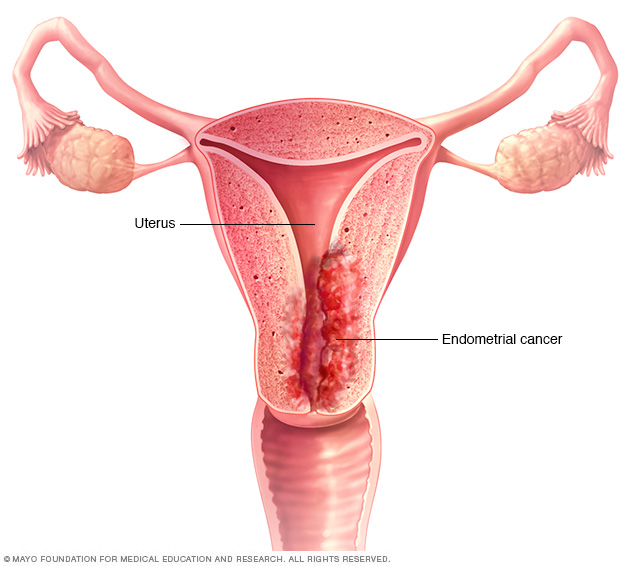 Laparoscopic oophorectomy - Mayo Clinic