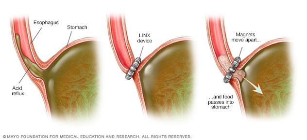 Gastroesophageal reflux disease (GERD) // Middlesex Health