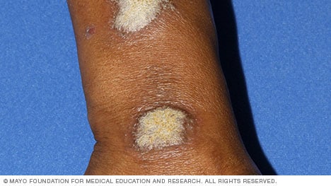 Plaque psoriasis