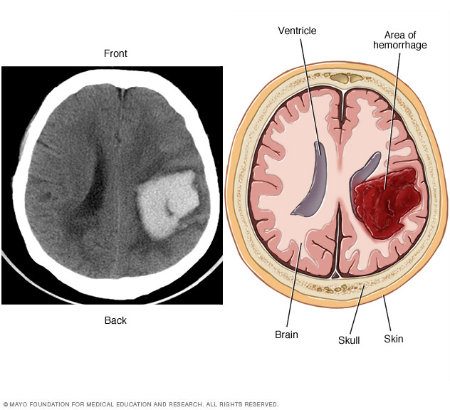 Intracerebral hemorrhage