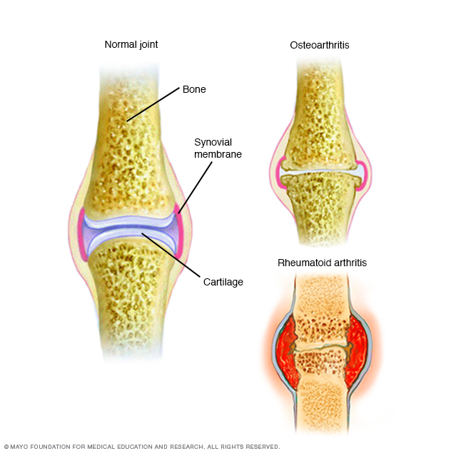 Osteoarthritis - Connecticut Orthopaedics