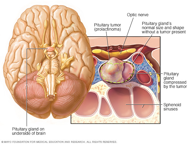 Prolactinoma en la glándula pituitaria