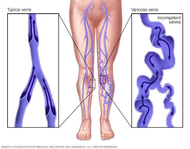 Fie osteopat varicose, Osteopat și vene varicoase