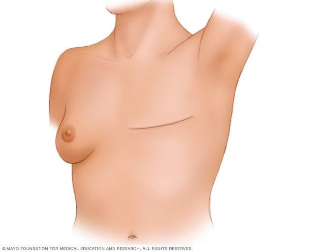 A person who has undergone a total (simple) mastectomy without breast reconstruction