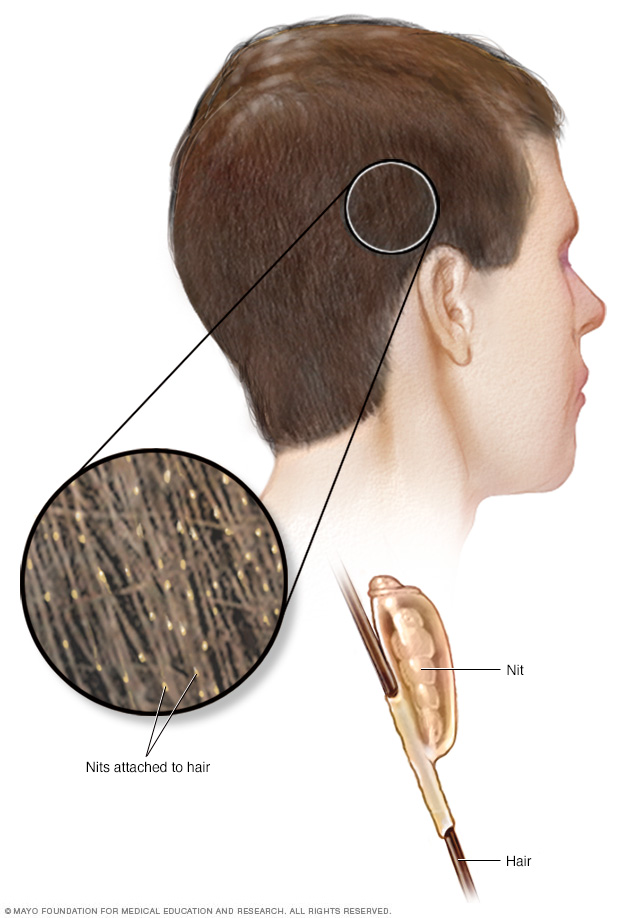  Nix Lice Removal Comb, Removes Dead Lice & Eggs from Hair,  2-Sided