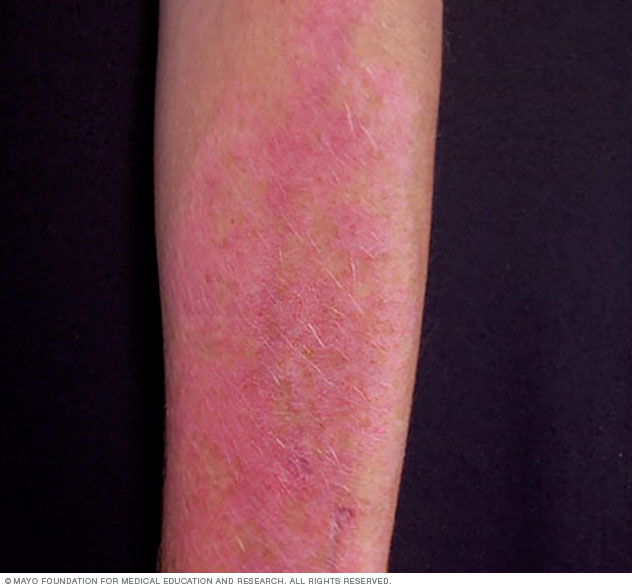 Polymorphous light eruption on arm